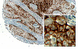 Cervical Squamous Cell Carcinoma: EGFR — Anti-Rabbit HRP